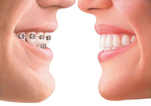 Aparelho Dentário Ortodontia Aparelho Dentário Ortodontia
