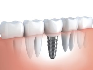 Implante de Dentes Implante de Dentes