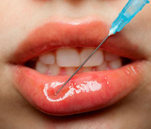 Preenchimento Labial Preenchimento Labial