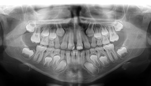 Raio X de Dentes Raio X de Dentes