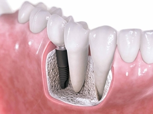 Tratamento de Canal Dentário Tratamento de Canal Dentário